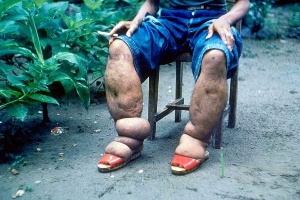 Lymphatic filariasis (Photo: CDC)